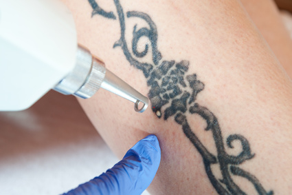 Appointment Apps For Tattoo Removal 