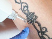 Appointment Apps For Tattoo Removal